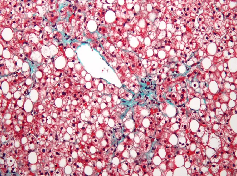 Micrografia di tessuto epatico con accumulo di grasso e fibrosi