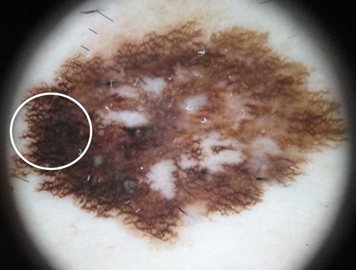 Immagine dermoscopica di melanoma cutaneo
