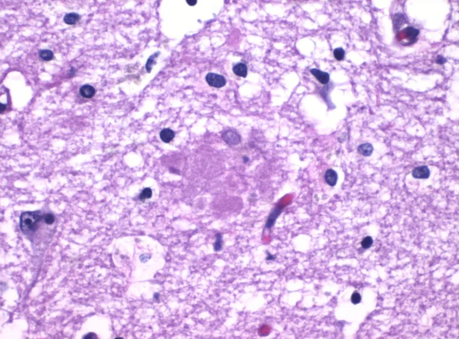 Micrografia di una placca amiloide associata alla malattia di Alzheimer