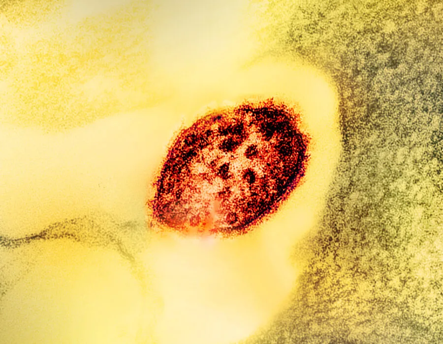 Micrografia colorizzata di una particella del virus del morbillo