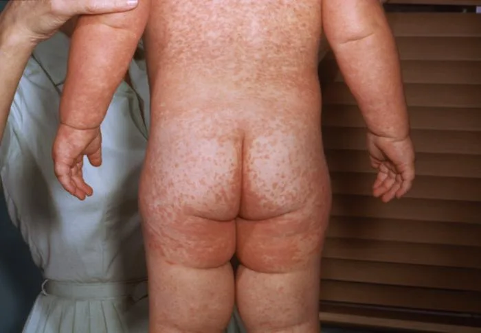 Eruzione cutanea da morbillo su un bambino
