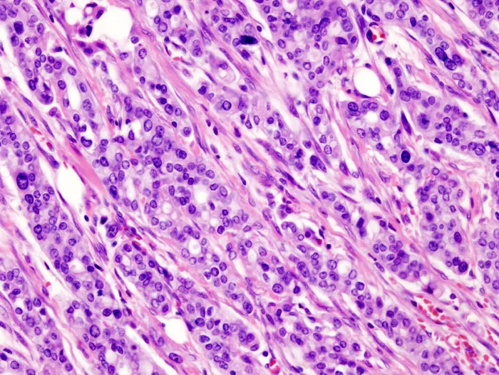 Sezione istologica di adenocarcinoma del pancreas colorata con ematossilina ed eosina