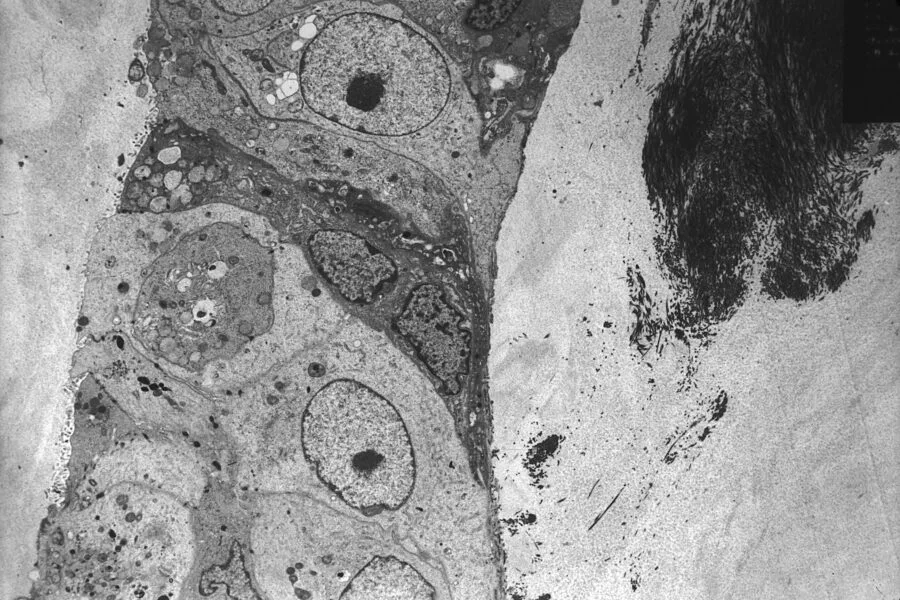 Cellule di tumore mammario viste al microscopio elettronico